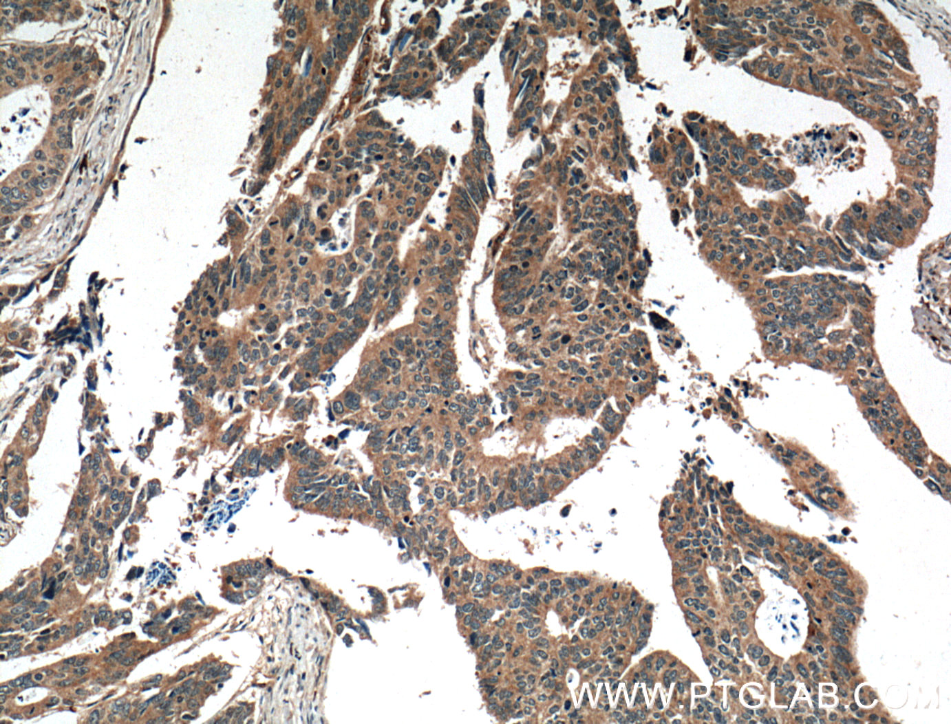 IHC staining of human colon cancer using 14497-1-AP