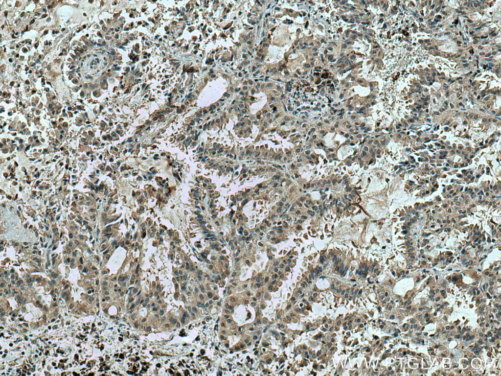 IHC staining of human lung cancer using 67381-1-Ig (same clone as 67381-1-PBS)