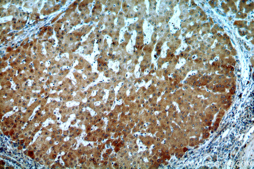 IHC staining of human hepatocirrhosis using 14329-1-AP