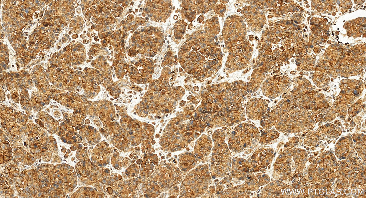 Immunohistochemical analysis of paraffin-embedded human stomach cancer tissue slide using 20319-1-AP (TSPAN8 antibody) at dilution of 1:500 (under 20x lens). Heat mediated antigen retrieval with Tris-EDTA buffer (pH 9.0). IHC staining of human stomach cancer using 20319-1-AP