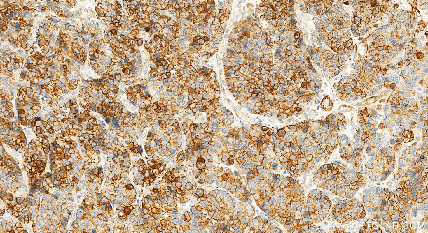 IHC staining of human stomach cancer using 87700-3-RR