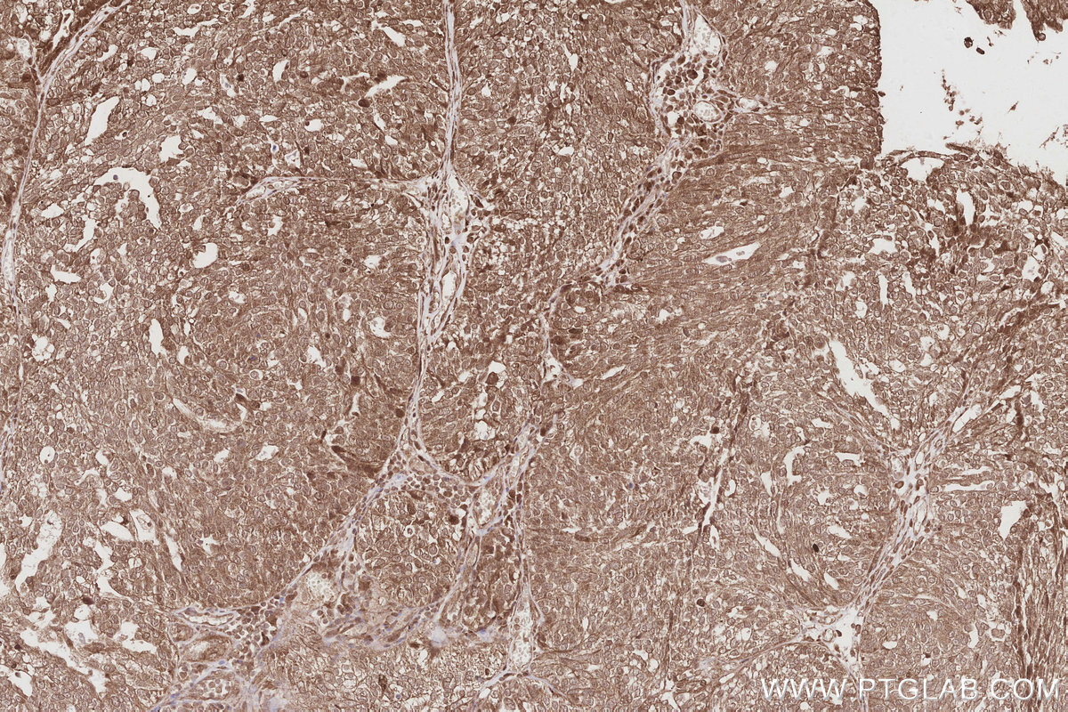 IHC staining of human ovary cancer using 12087-2-AP