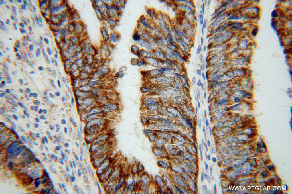 IHC staining of human colon cancer using 16311-1-AP