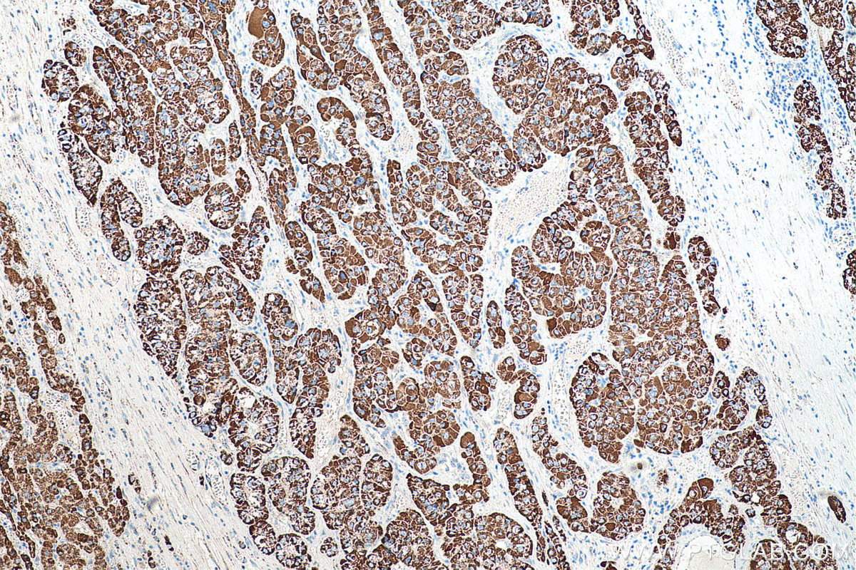IHC staining of human liver cancer using 66018-1-Ig (same clone as 66018-1-PBS)