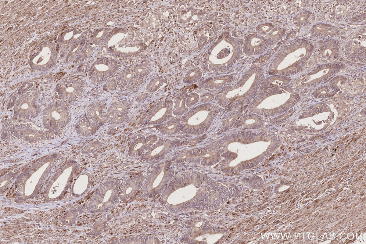 IHC staining of human rectal cancer using 25701-1-AP