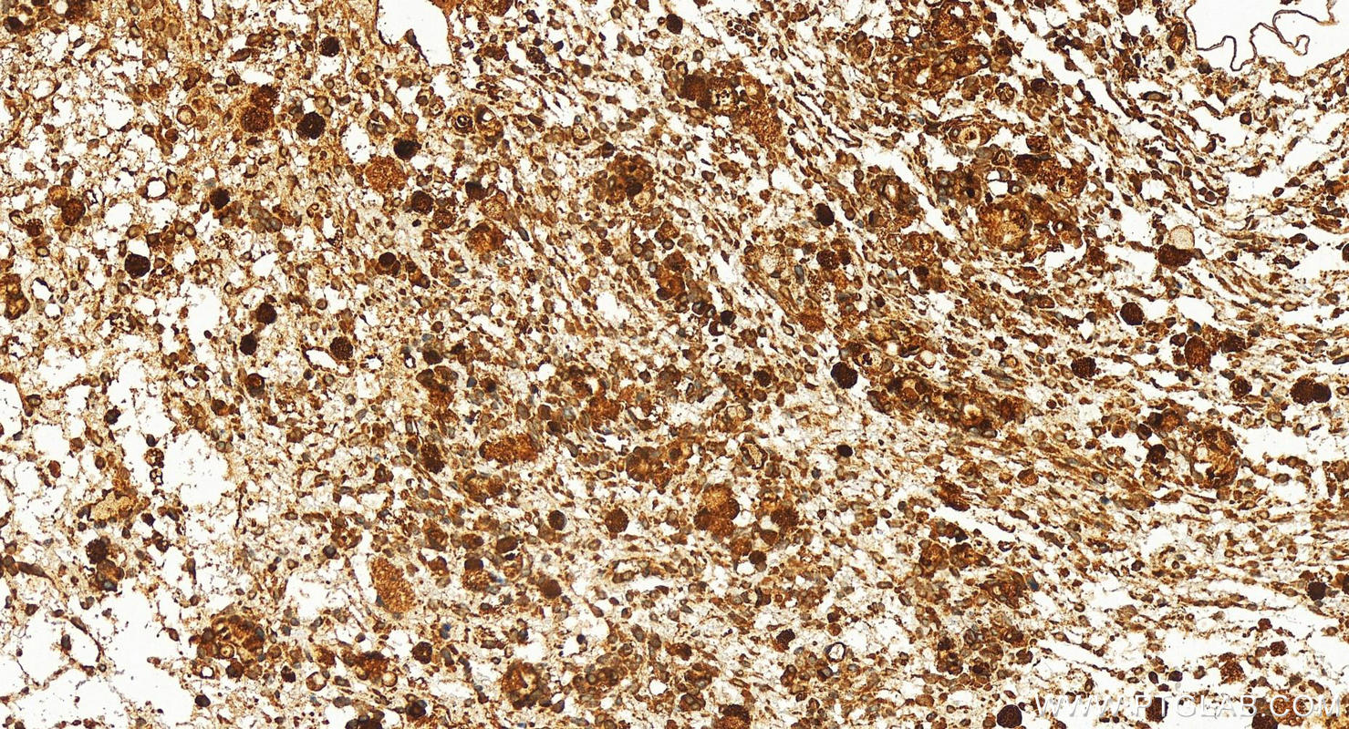 Immunohistochemical analysis of paraffin-embedded human ovary cancer tissue slide using 25443-1-AP (TTC35 antibody) at dilution of 1:200 (under 20x lens). Heat mediated antigen retrieval with Tris-EDTA buffer (pH 9.0). IHC staining of human ovary cancer using 25443-1-AP