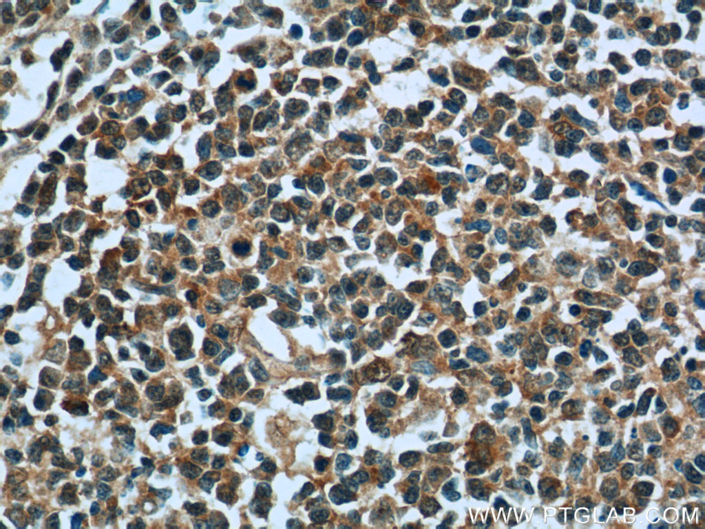 IHC staining of human tonsillitis using 24594-1-AP