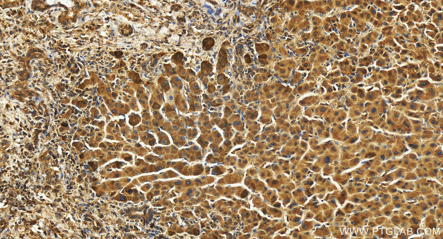 IHC staining of human intrahepatic cholangiocarcinoma using 25410-1-AP