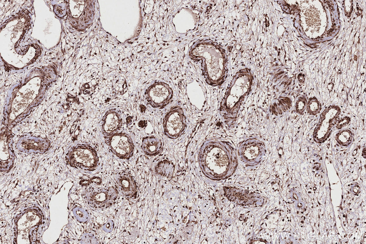 IHC staining of human ovary cancer using 25410-1-AP