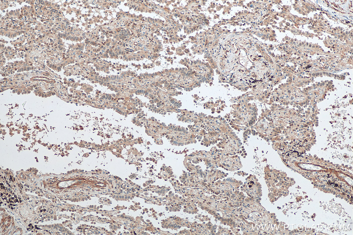 IHC staining of human lung cancer using 68044-1-Ig (same clone as 68044-1-PBS)