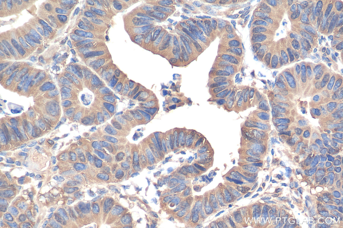 IHC staining of human colon cancer using 11224-1-AP