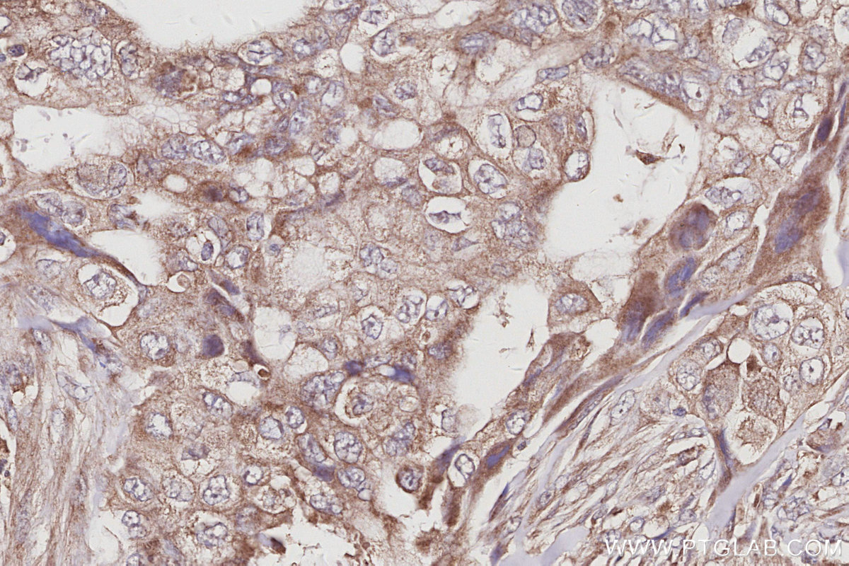 IHC staining of human pancreas cancer using 27433-1-AP