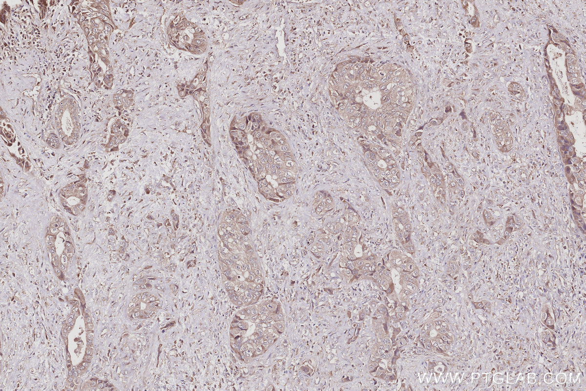 IHC staining of human pancreas cancer using 27433-1-AP IHC staining of human pancreas cancer using 27433-1-AP