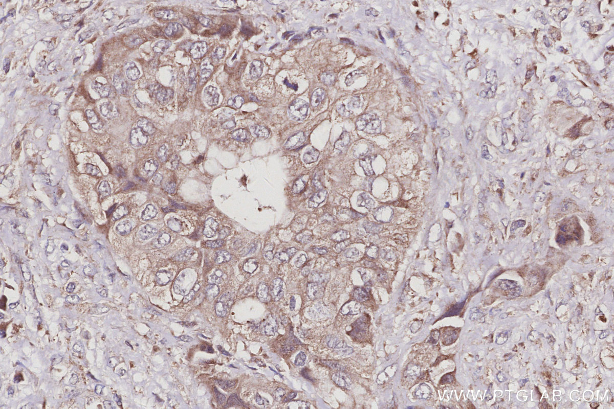 IHC staining of human pancreas cancer using 27433-1-AP