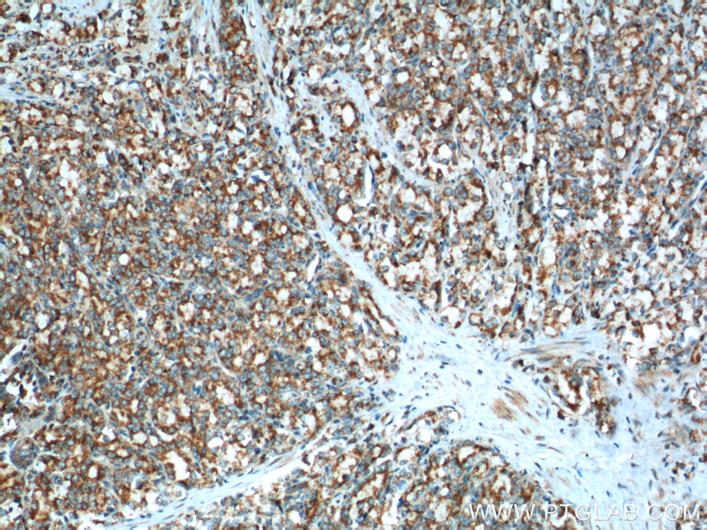 IHC staining of human prostate cancer using 15176-1-AP