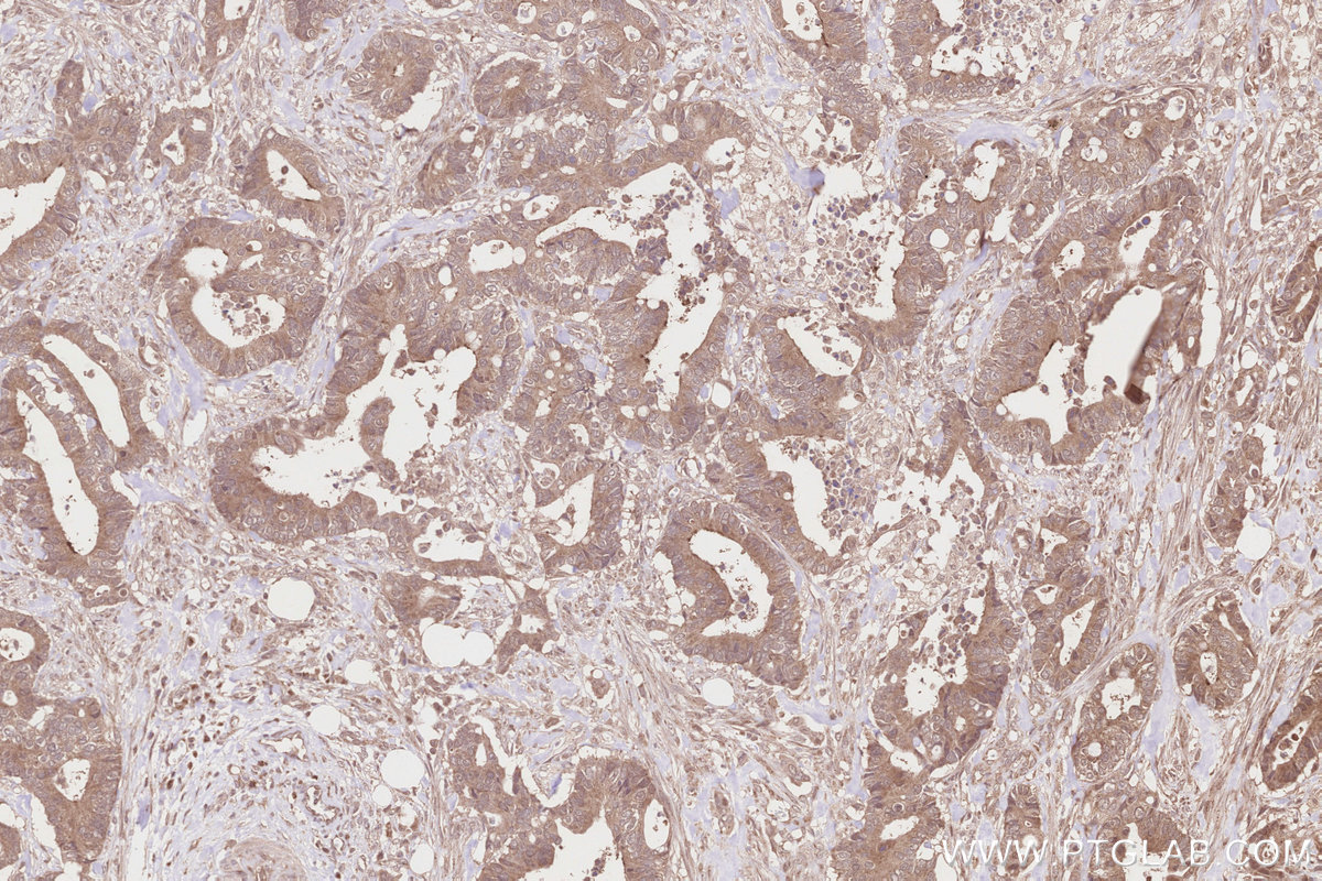 IHC staining of human rectal cancer using 14620-1-AP IHC staining of human rectal cancer using 14620-1-AP