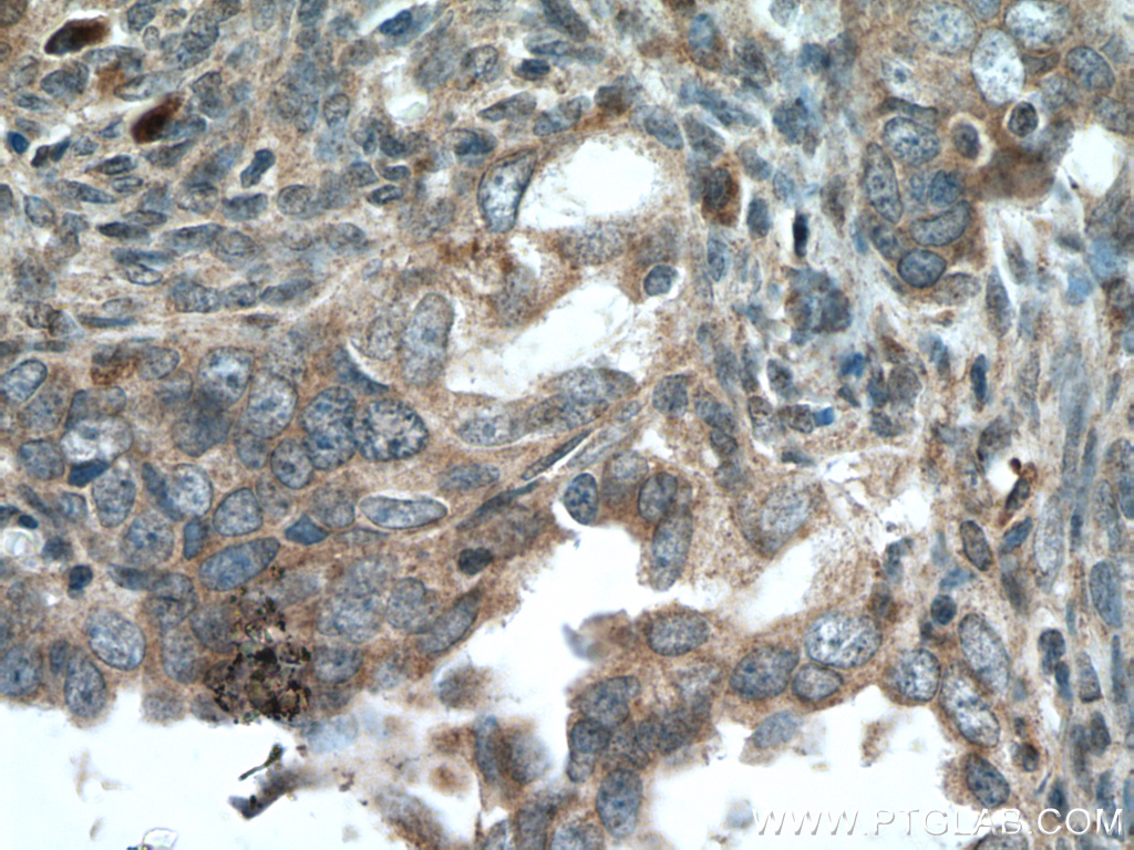 IHC staining of human ovary tumor using 13637-1-AP
