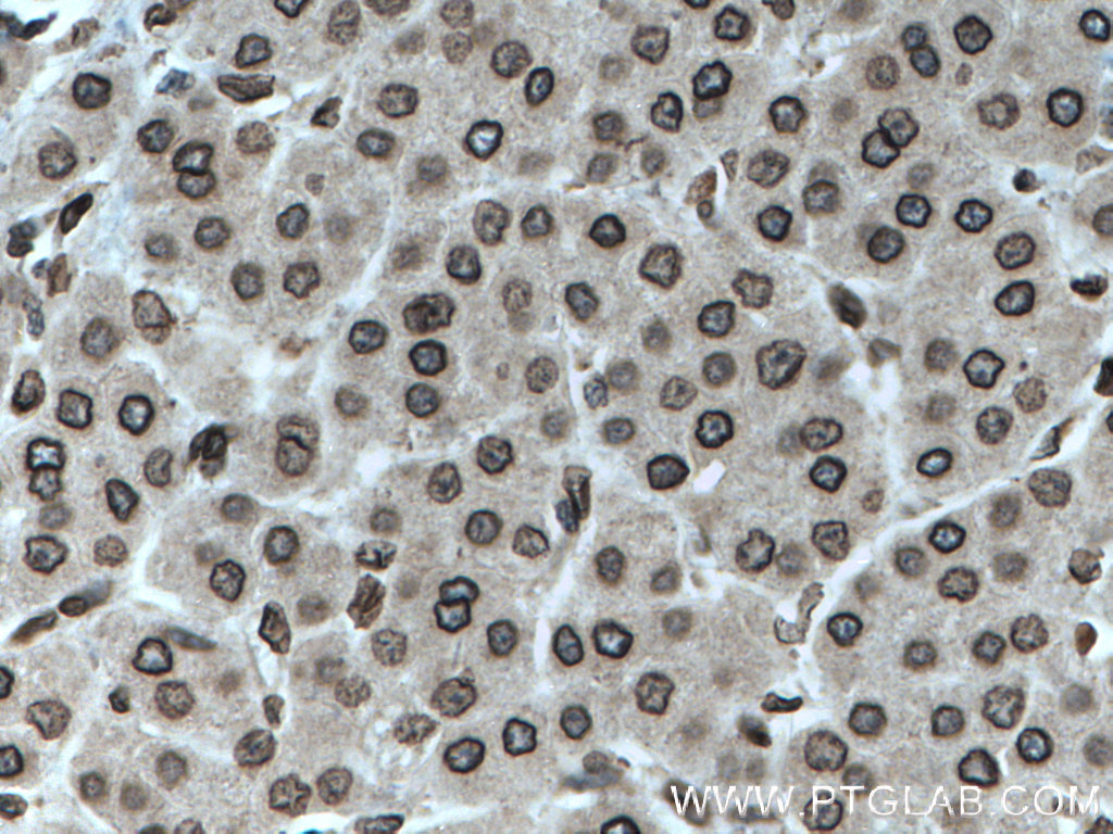 IHC staining of human liver cancer using 25465-1-AP