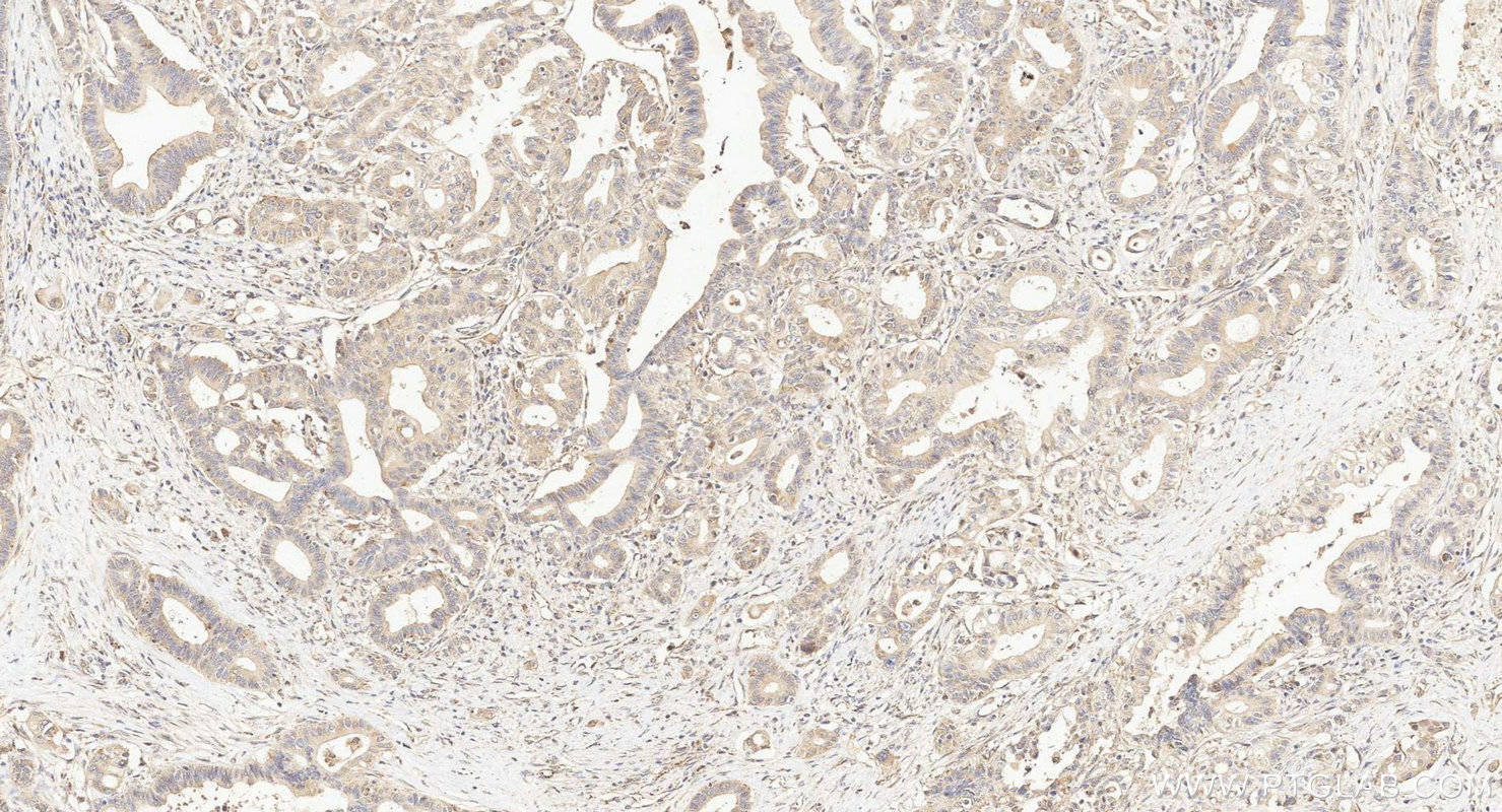 IHC staining of human pancreas cancer using 27558-1-AP