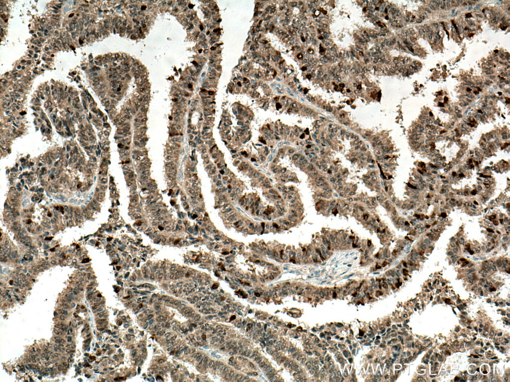 IHC staining of human ovary tumor using 66475-1-Ig