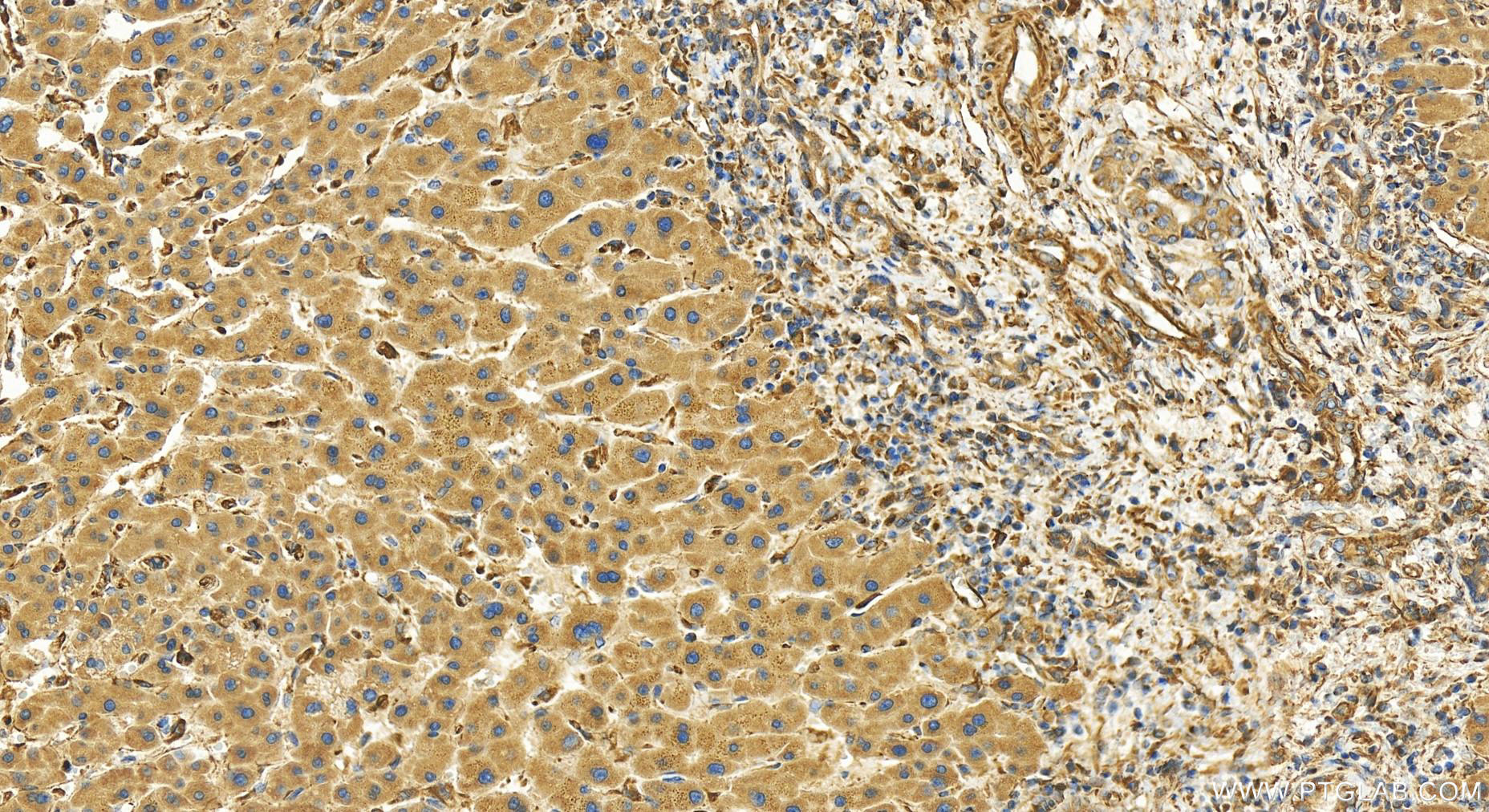 IHC staining of human intrahepatic cholangiocarcinoma using 25687-1-AP