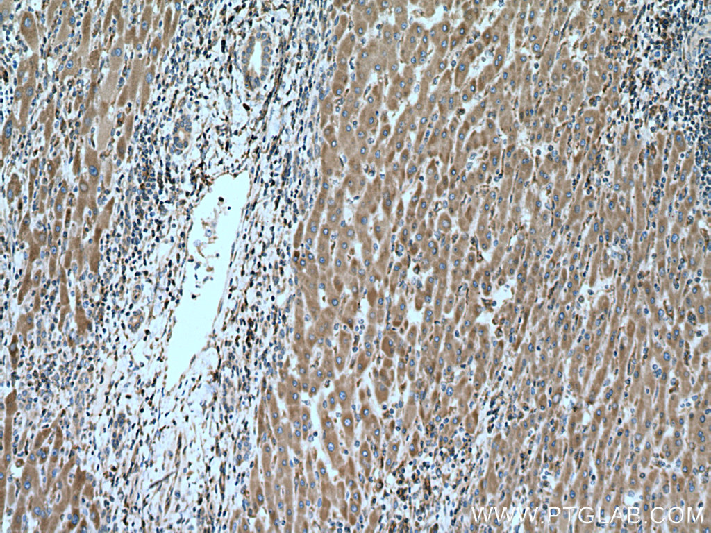 IHC staining of human liver cancer using 20181-1-AP