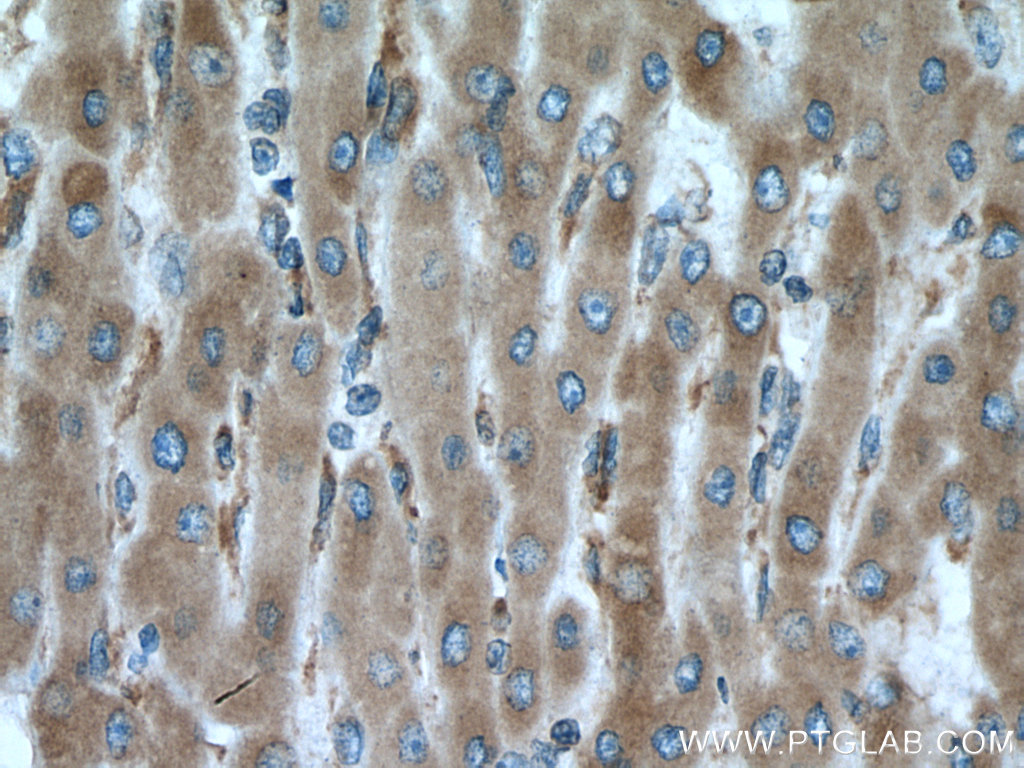 IHC staining of human liver cancer using 20181-1-AP