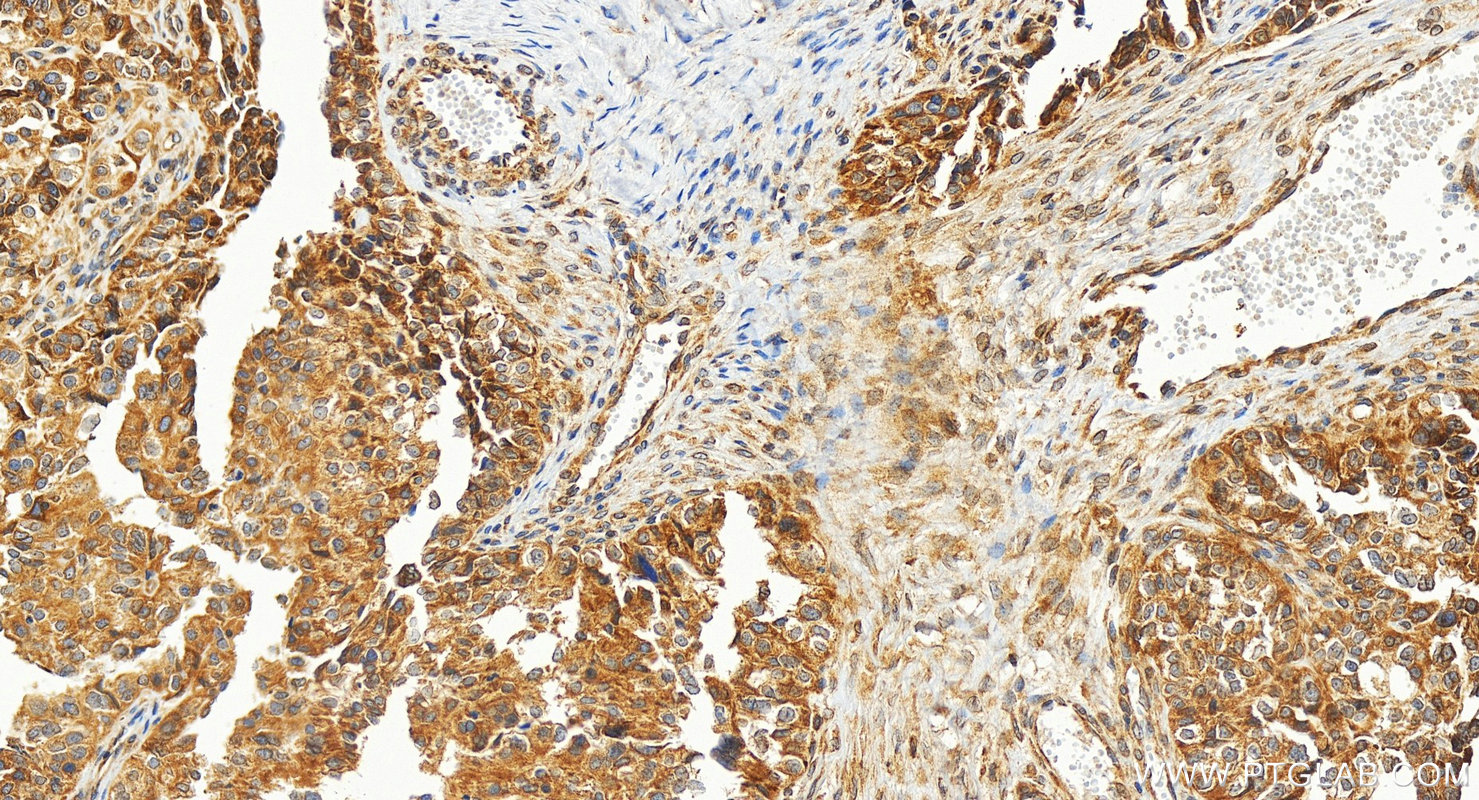 IHC staining of human ovary cancer using 32874-1-AP