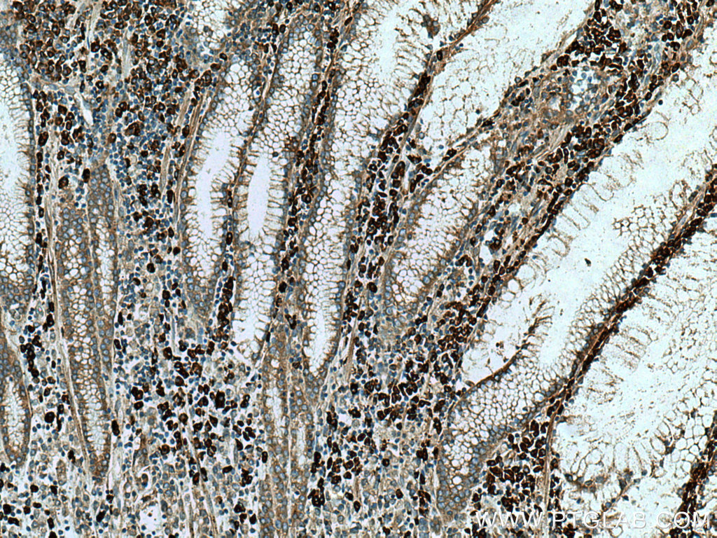 IHC staining of human stomach cancer using 19834-1-AP