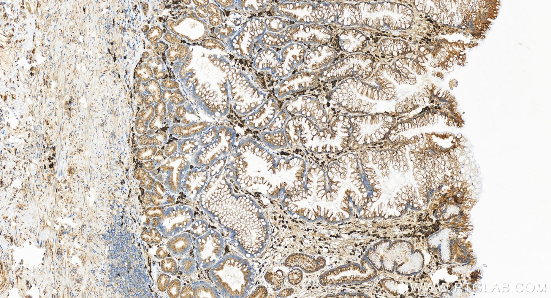 IHC staining of human stomach cancer using 84756-5-RR
