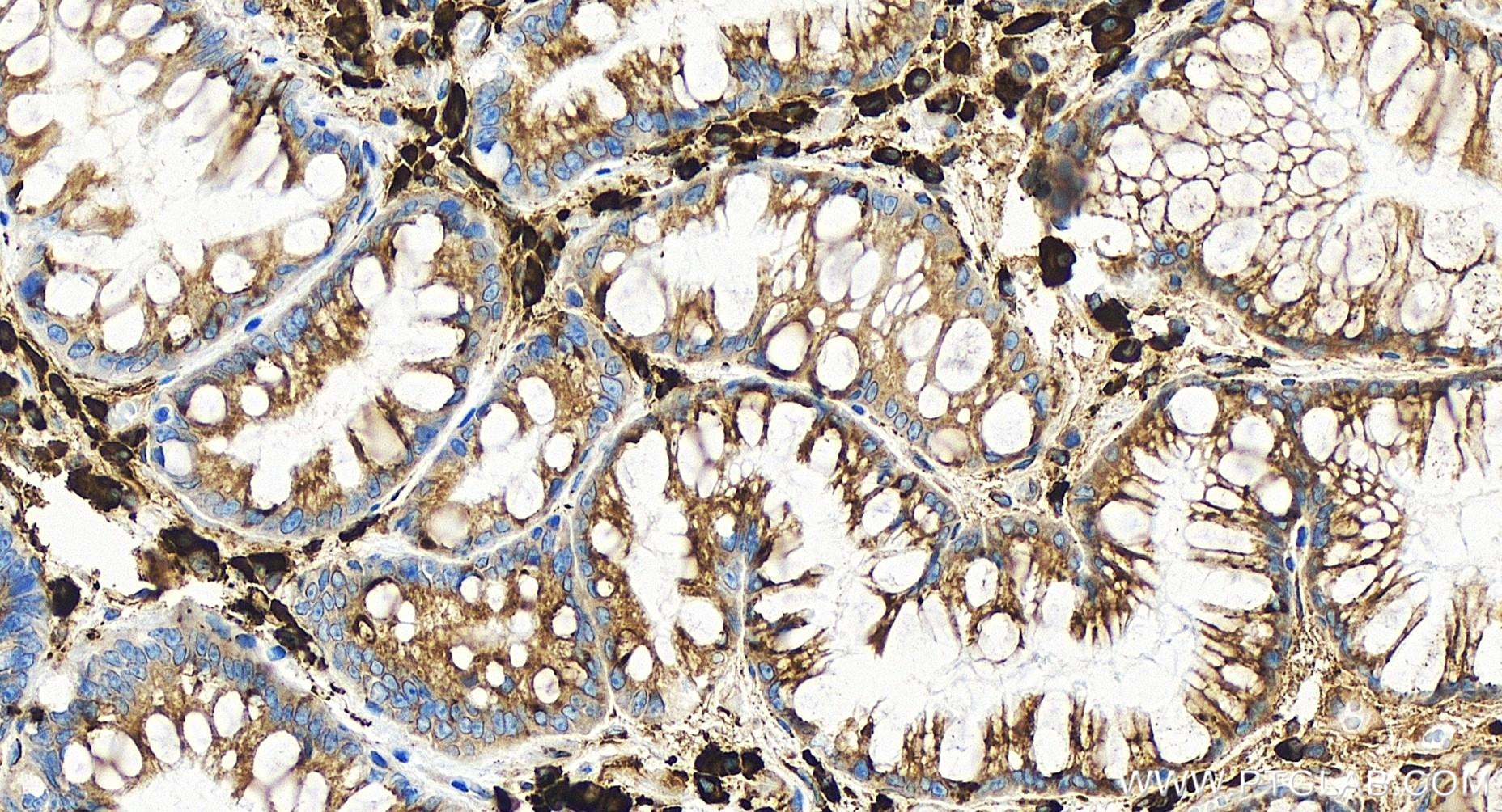 IHC staining of human stomach cancer using 84756-5-RR