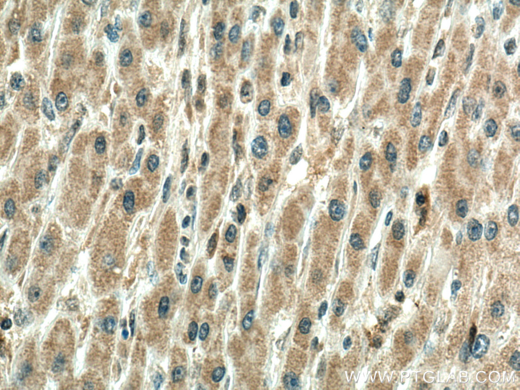 IHC staining of human liver cancer using 67728-1-Ig