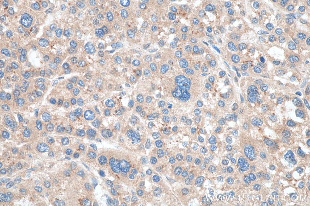 IHC staining of human liver cancer using 16412-1-AP (same clone as 16412-1-PBS)
