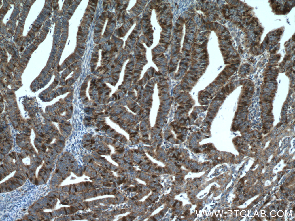 IHC staining of human endometrial cancer using 15047-1-AP