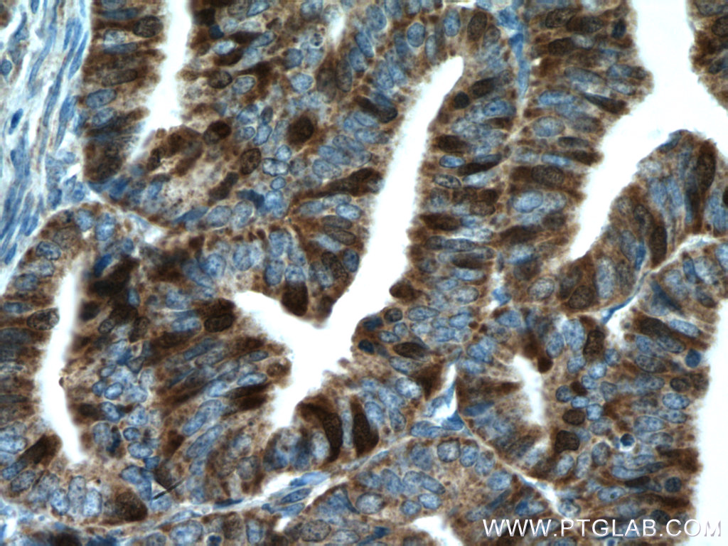 IHC staining of human endometrial cancer using 15047-1-AP