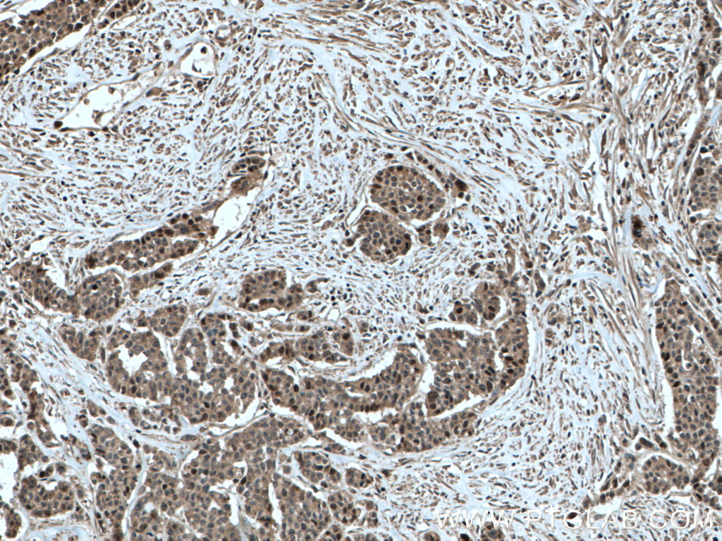 IHC staining of human colon cancer using 66725-1-Ig