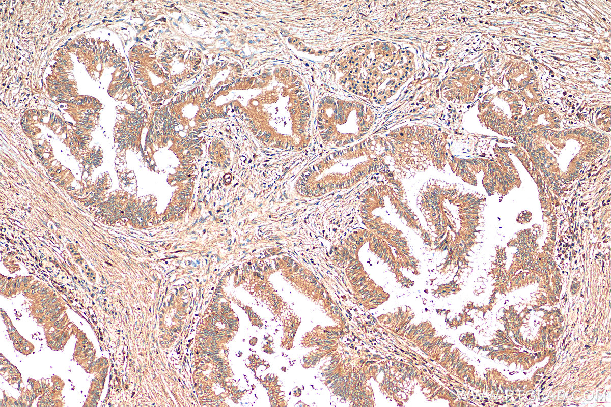 IHC staining of human pancreas cancer using 66725-1-Ig