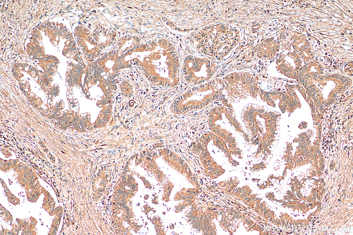 IHC staining of human pancreas cancer using 66725-1-Ig (same clone as 66725-1-PBS)