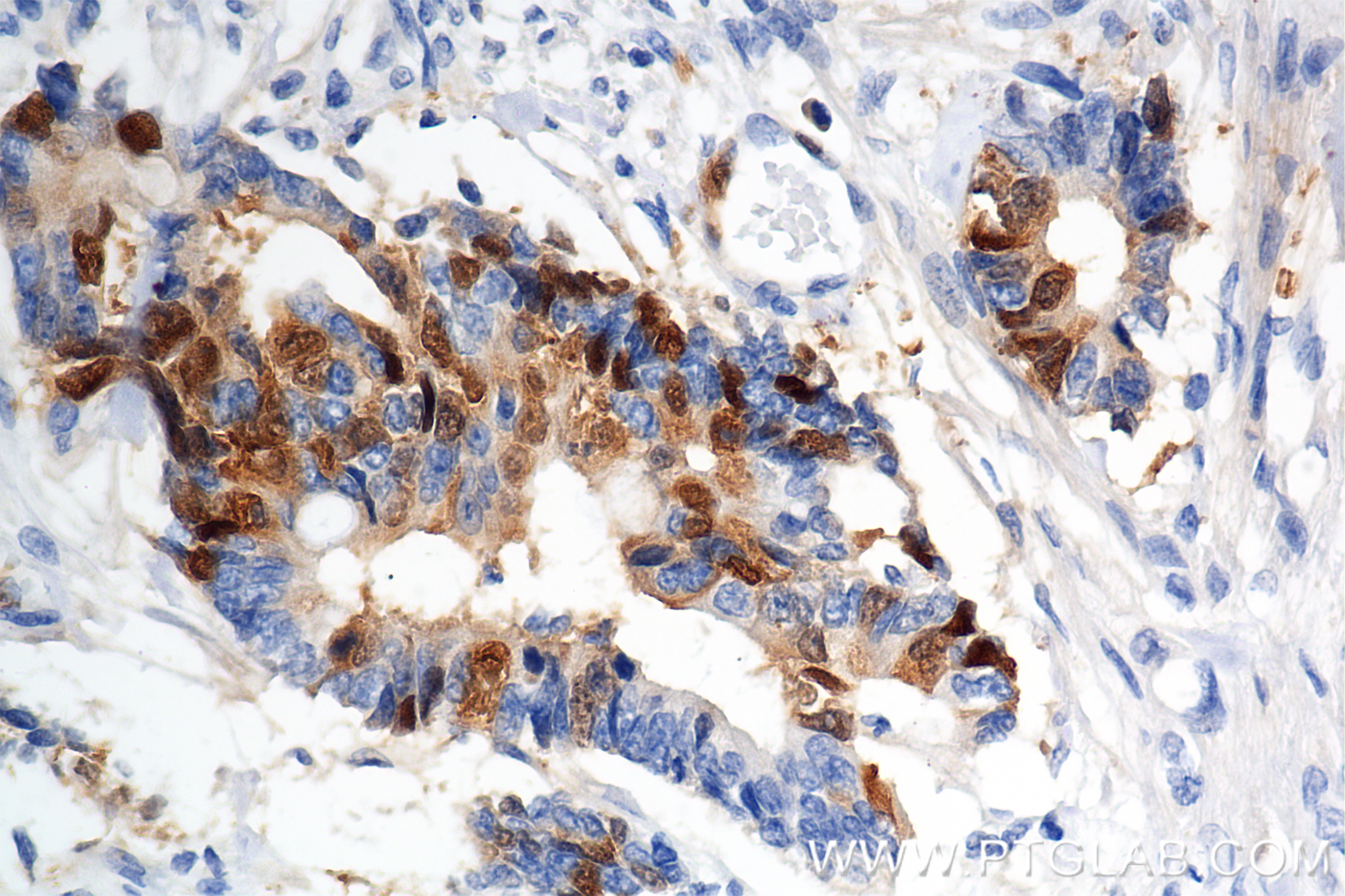 IHC staining of human rectal cancer using 86643-1-RR IHC staining of human rectal cancer using 86643-1-RR