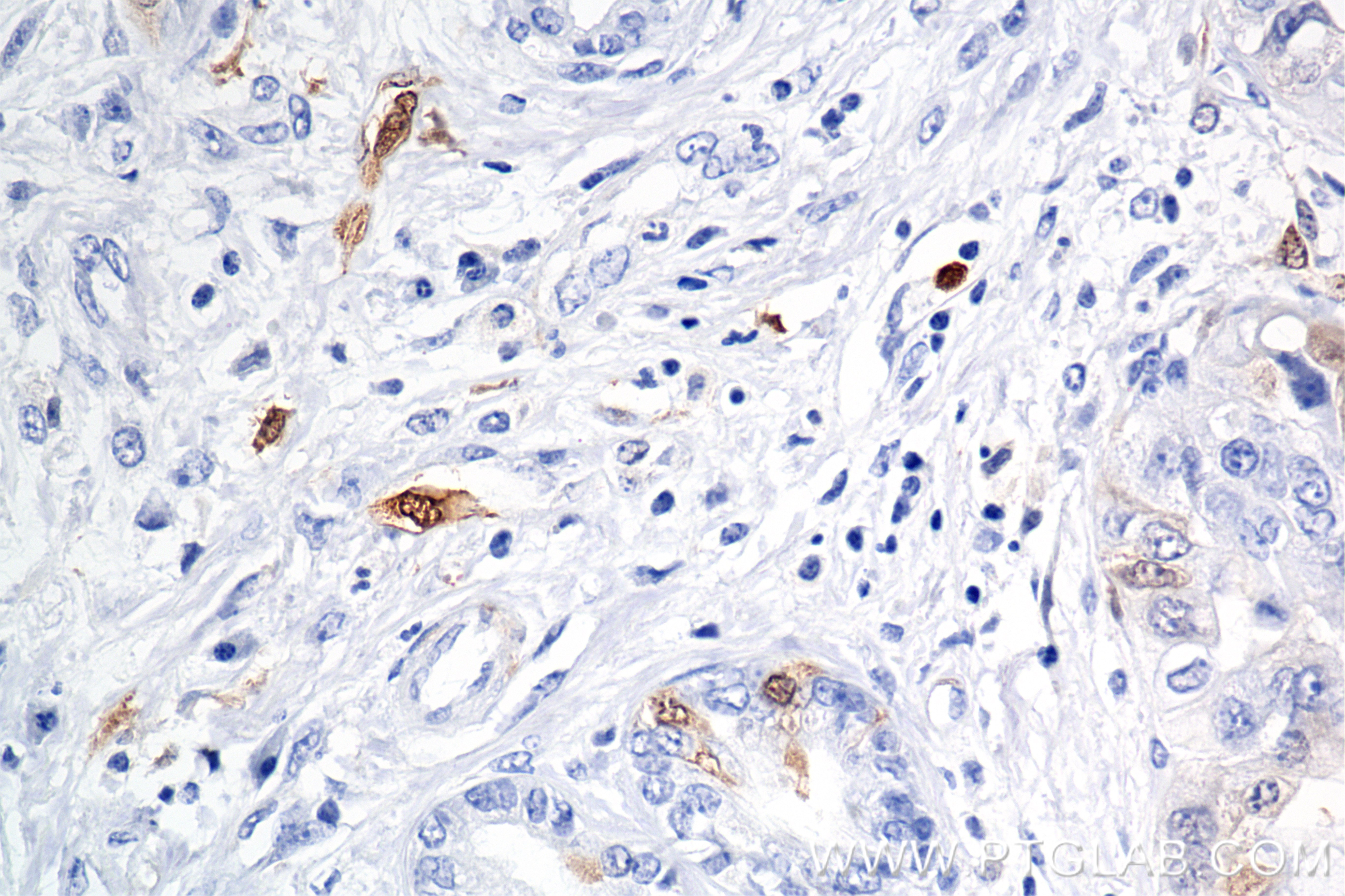 IHC staining of human pancreas cancer using 86643-1-RR IHC staining of human pancreas cancer using 86643-1-RR