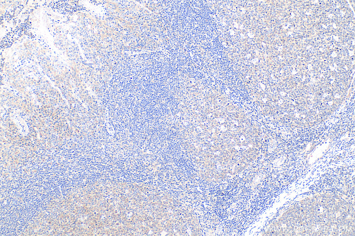 Immunohistochemical analysis of paraffin-embedded human tonsillitis tissue slide using 83627-1-RR (Timp-3 antibody) at dilution of 1:400 (under 10x lens). Heat mediated antigen retrieval with Tris-EDTA buffer (pH 9.0). IHC staining of human tonsillitis using 83627-1-RR