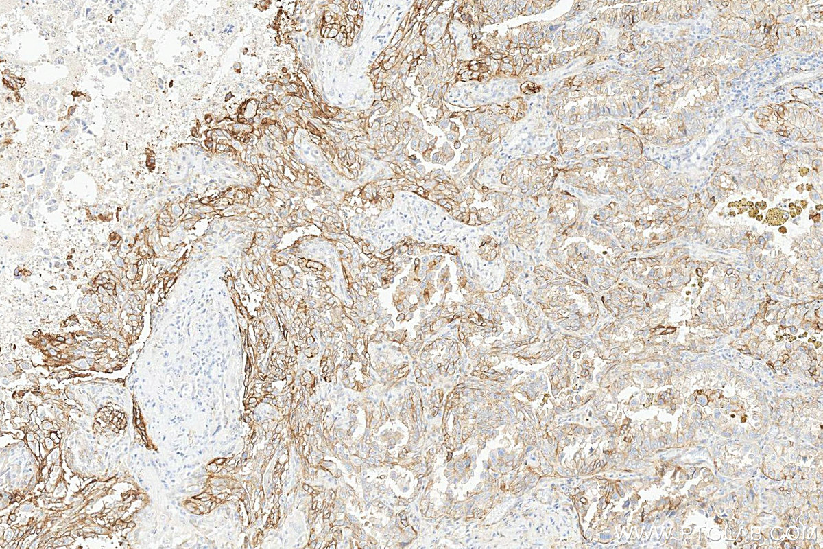 IHC staining of human lung cancer using 31453-1-AP IHC staining of human lung cancer using 31453-1-AP
