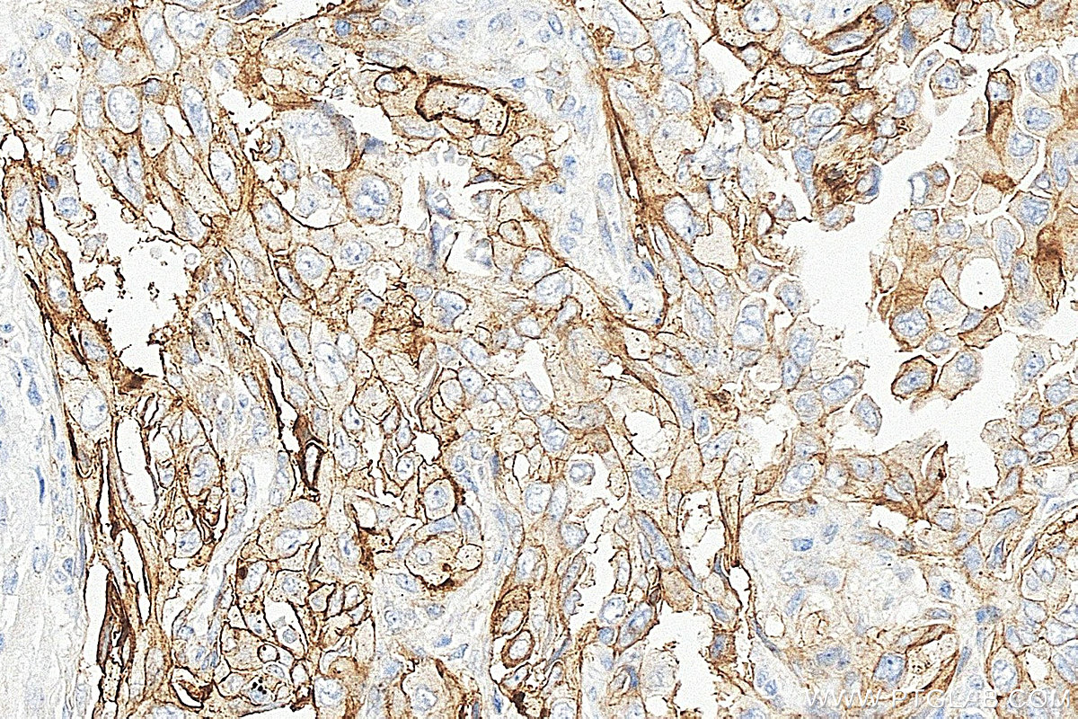 IHC staining of human lung cancer using 31453-1-AP IHC staining of human lung cancer using 31453-1-AP