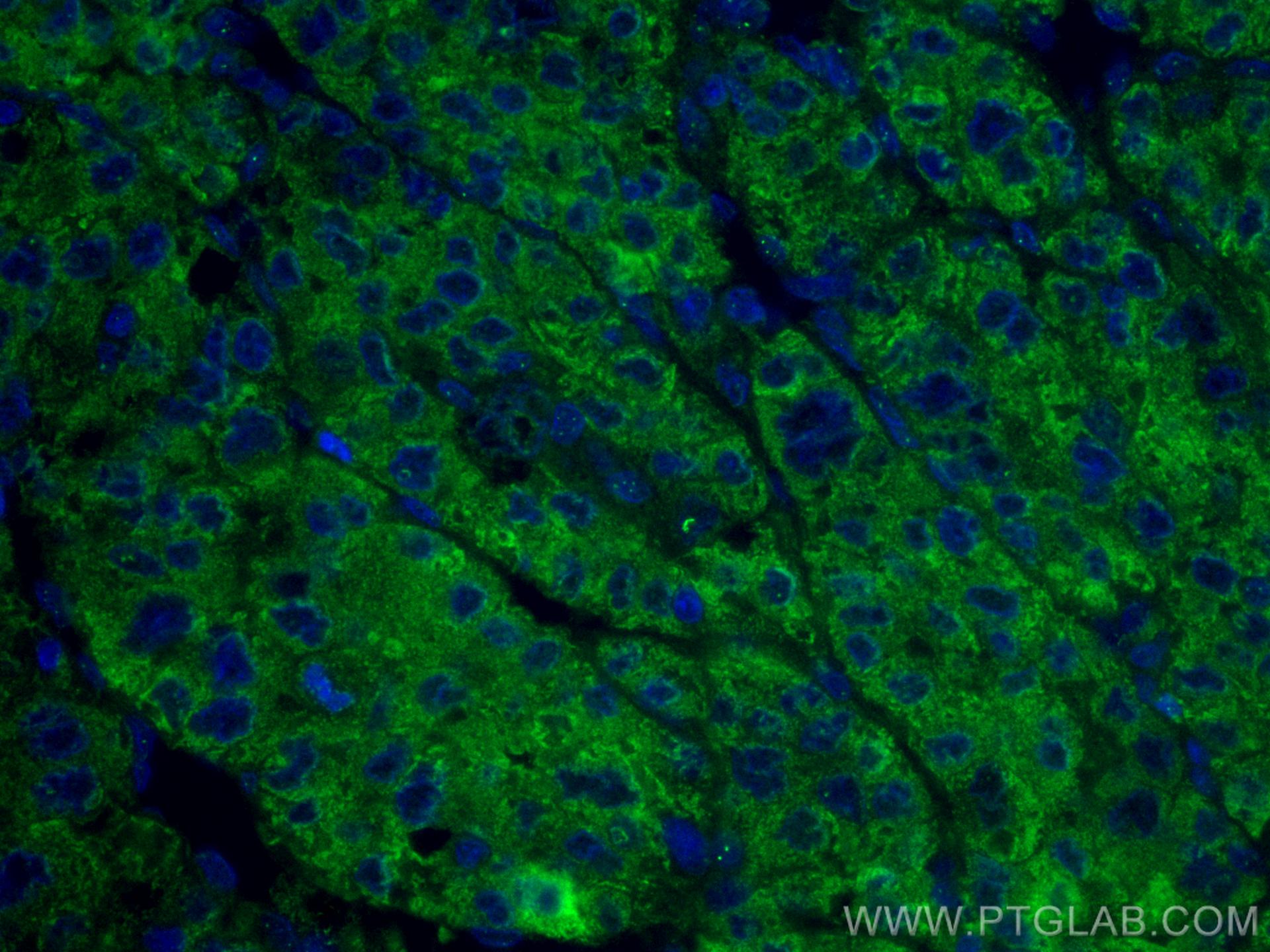 IF Staining of human liver cancer using CL488-66171