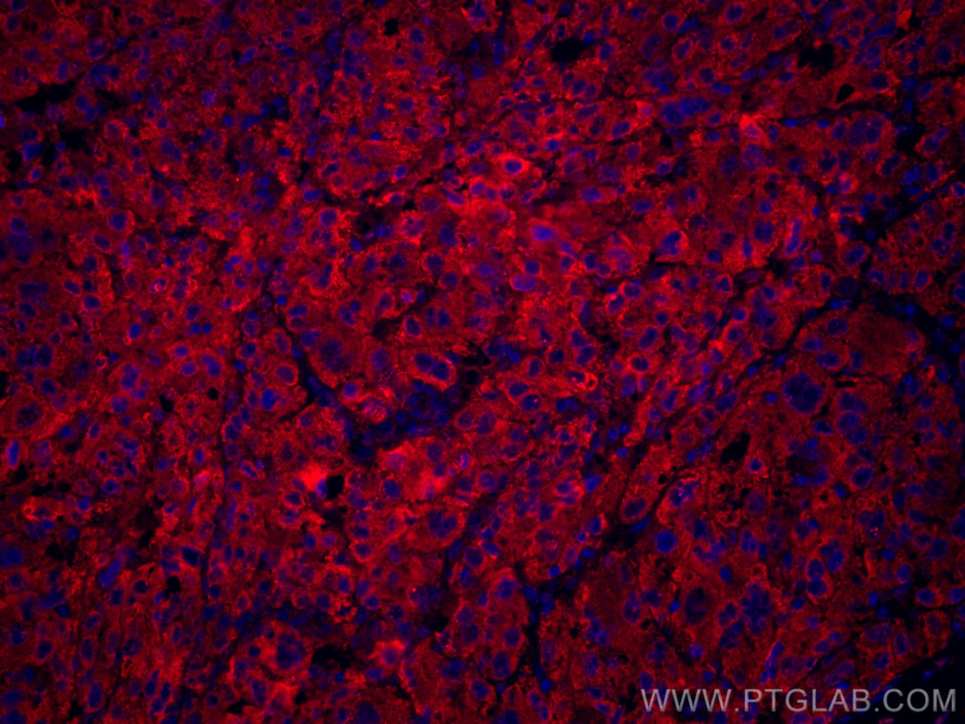 IF Staining of human liver cancer using CL594-66171