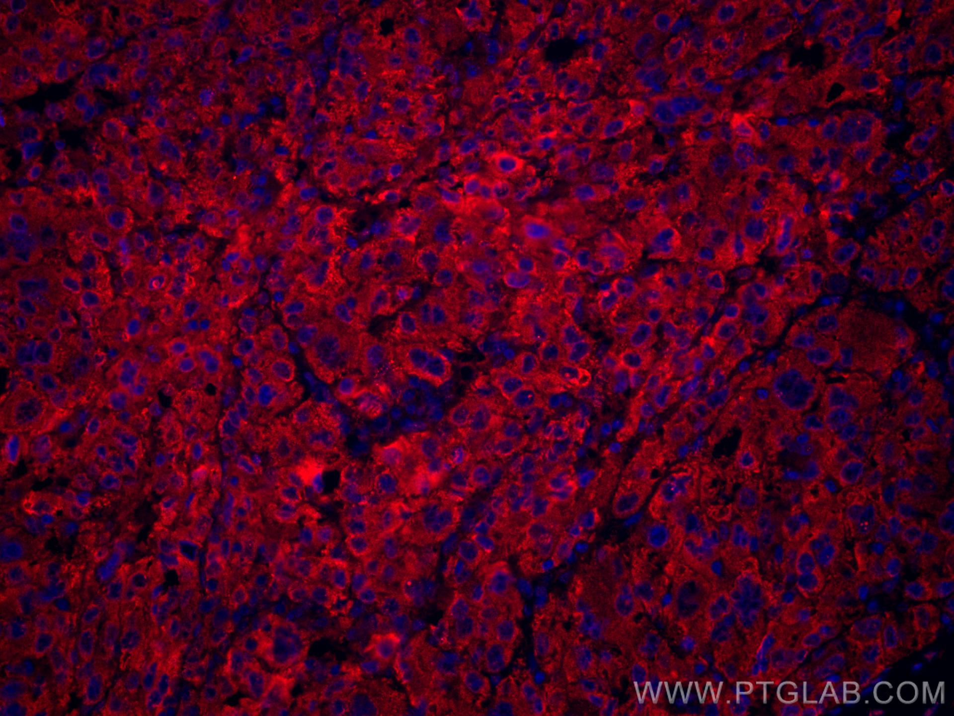 IF Staining of human liver cancer using CL594-66171