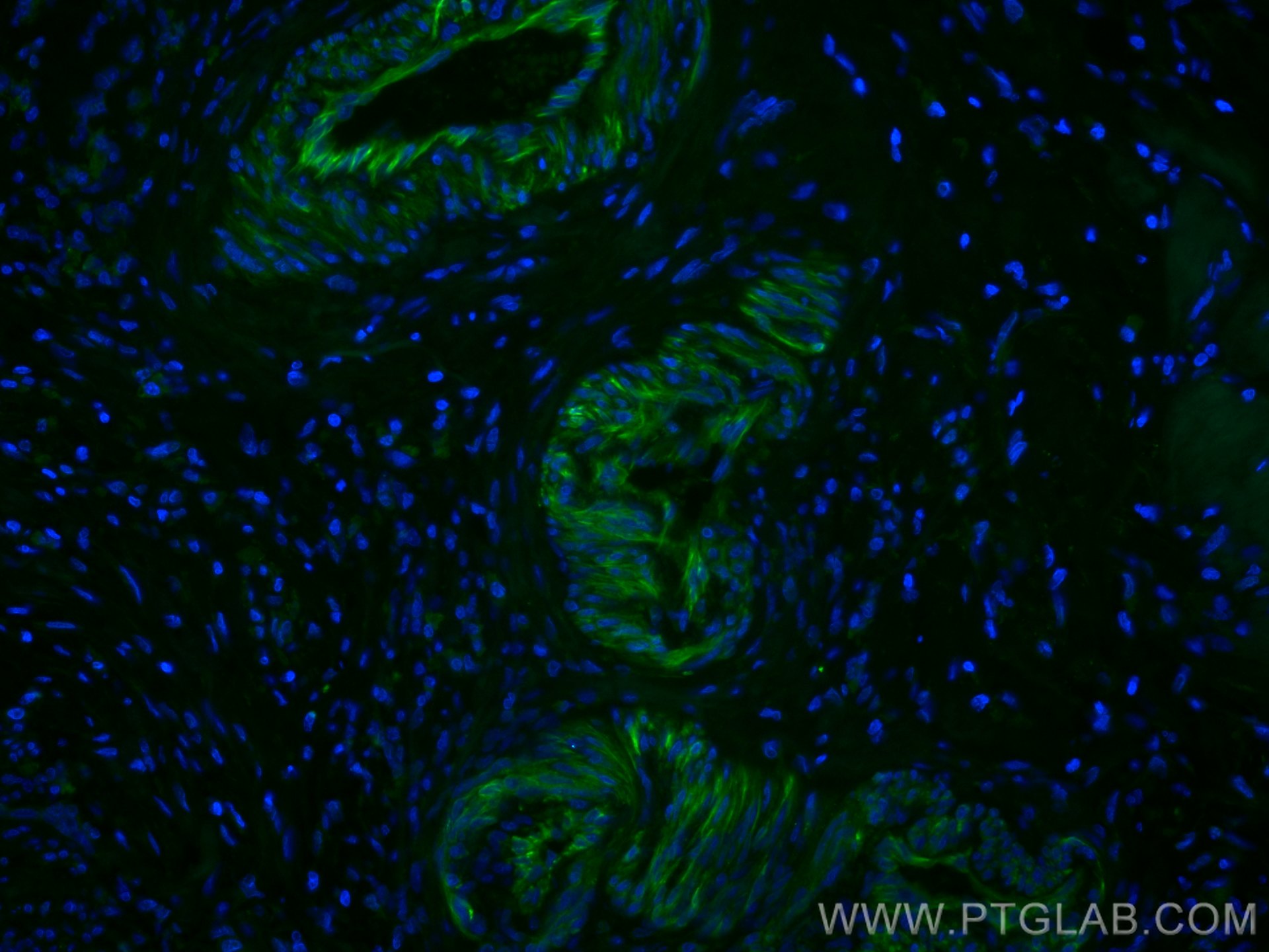 IF Staining of human colon cancer using CL488-60044