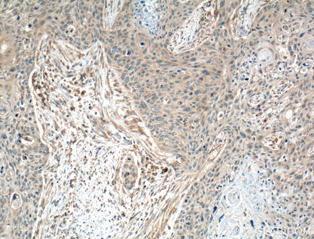 IHC staining of human oesophagus cancer using 15508-1-AP
