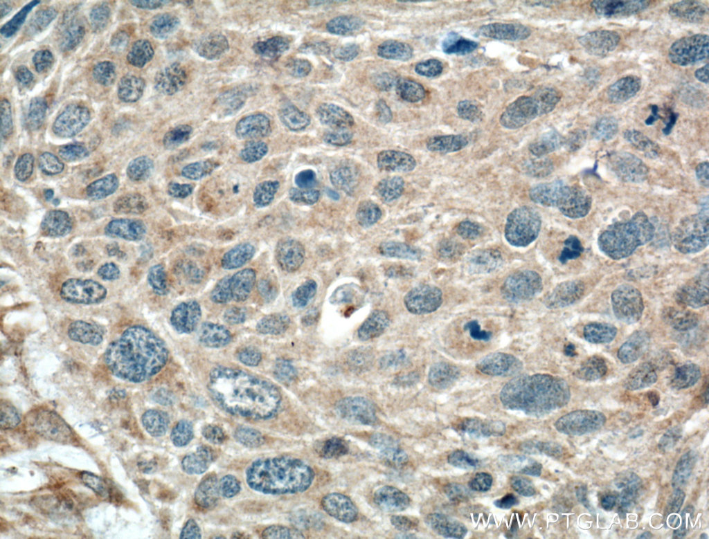 IHC staining of human oesophagus cancer using 15508-1-AP
