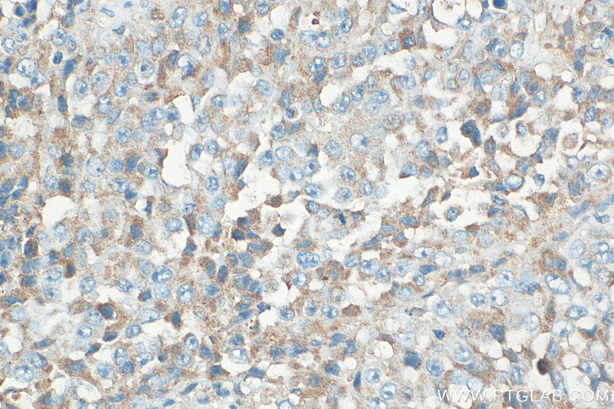 IHC staining of human malignant melanoma using 31291-1-AP IHC staining of human malignant melanoma using 31291-1-AP